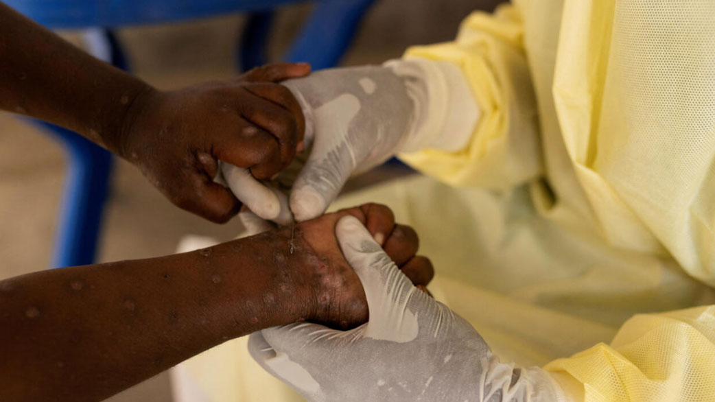 África habría superado los 18 mil casos de mpox